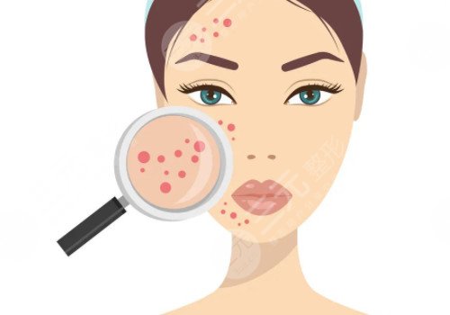 臉上長(zhǎng)痘印如何消除?