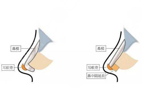 自體軟骨隆鼻多少錢？