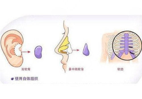 自體軟骨隆鼻多少錢？