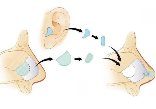 自體軟骨隆鼻多少錢？