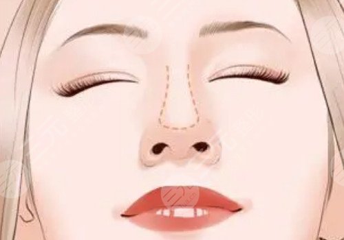 自體軟骨隆鼻多少錢？