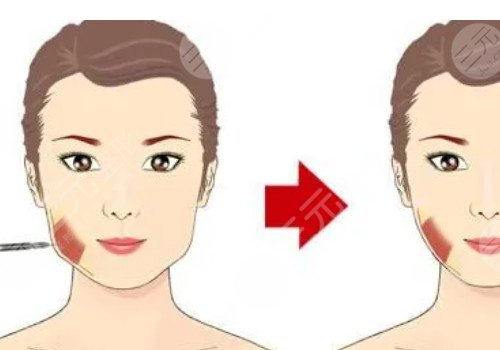 咬肌發(fā)達怎么瘦下來?