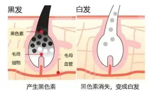 長白頭發(fā)了是什么原因導致的?
