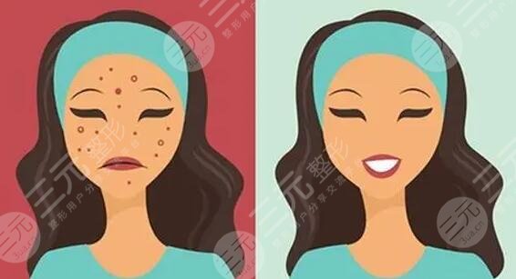 　　臉上的痘坑怎么去掉?隨著年齡的增長(zhǎng)，不少人臉上都出現(xiàn)了青春痘或者是長(zhǎng)痘的情況，這些多數(shù)是由內(nèi)分泌失調(diào)和皮膚油脂平衡失調(diào)造成的，首先在發(fā)現(xiàn)自己長(zhǎng)痘之后，就需要通過正規(guī)的祛痘手術(shù)去除痘痘才行，如果是不正規(guī)的方法就容易造成痘坑、痘印，對(duì)于小伙伴們來說，痘坑痘印比痘痘更讓人難受，目前國(guó)內(nèi)可以去痘坑的方法有很多，都是國(guó)內(nèi)祛痘坑成功的小伙伴們選擇的技術(shù)手段，下面就有小編一一來為大家做一個(gè)介紹!  　　1、臉上的痘坑怎么去掉更有?  　　(1)、激光祛痘坑，利用高熱能量的激光，在皮膚表面進(jìn)行照射，光能對(duì)痘坑位置有一定的刺激作用，能夠刺激膠原蛋白的再生和膠原纖維的修復(fù)生長(zhǎng)，從而達(dá)到修復(fù)痘坑的果。  　　(2)、果酸換膚，果酸換膚主要是在痘坑皮膚表面涂抹果酸，利用專業(yè)的器械設(shè)備刺激手術(shù)部位的皮膚細(xì)胞再生，加速痘坑區(qū)域的新陳代謝來達(dá)到去除痘坑，讓皮膚看起來光滑平整的手術(shù)果。  　　(3)、微針緩解，微針緩解是很多美容院都會(huì)采取的一種改良痘坑的方法，能夠?qū)⒍豢游恢玫钠つw層次重新進(jìn)行疏通，輸入一定的營(yíng)養(yǎng)物質(zhì)，使皮膚的修復(fù)能力上線來達(dá)到去除痘印的果。  　　(4)、填充祛除，填充的技術(shù)手段所針對(duì)的是痘坑，比較嚴(yán)重的人群，特有的一種技術(shù)方法，將專業(yè)的填充材料填充到痘坑凹陷比較嚴(yán)重的位置來讓痘坑平整。  　　(5)、DIY面膜，如果是針對(duì)于痘坑比較淺或者是新出現(xiàn)的痘坑的話，可以通過護(hù)膚品等方式來讓自己的痘坑有一定的修復(fù)果，其中比較受求美者喜歡的是蛋清珍珠粉，面膜蛋清和珍珠粉融合之后涂抹在面部一5到20分鐘左右，用清水清洗一周敷兩次左右，一段時(shí)間之后可以有一定淡化痘坑的果。  　　2、激光祛痘印痘坑多少錢?  　　激光去除痘坑痘印的價(jià)格通常在2千到一萬元不等，首先緩解面積是影響價(jià)格的關(guān)鍵，如果是小面積的痘坑，那么它的手術(shù)難度就比較小，費(fèi)用也會(huì)比較便宜，但如果是面積較大且又深的痘坑的話，那么它的收費(fèi)價(jià)格就會(huì)在8000元及以上。當(dāng)然醫(yī)院的選擇和地區(qū)的選擇也會(huì)影響到價(jià)格，3甲醫(yī)院的收費(fèi)要比2甲醫(yī)院更貴，私立的整形醫(yī)院和普通的門診部的收費(fèi)標(biāo)準(zhǔn)也有一定的區(qū)別，一線城市和3線城市的醫(yī)療標(biāo)準(zhǔn)也有較大的不同。除了以上兩點(diǎn)以外醫(yī)生的選擇其實(shí)也會(huì)影響到價(jià)格收費(fèi)情況，實(shí)習(xí)醫(yī)生和的祛痘坑醫(yī)生，它的收費(fèi)標(biāo)準(zhǔn)都是不一樣的。  　　3、激光去痘坑要做幾次?  　　一般情況下，激光去痘坑要做3到5次時(shí)間，它主要是通過皮膚表層深入到皮膚層，為此促進(jìn)皮膚膠原蛋白的再生來改良痘坑問題，但每一個(gè)人的實(shí)際情況是不一樣的，如如果是痘坑比較淺的求美者的話。那么他的激光祛痘坑3次就可以有良好的改良果，反之則要五次。  　　4、微晶磨皮和點(diǎn)陣激光哪個(gè)比較好?  　　這之間都是激光的一種，都可以運(yùn)用到去除疤痕，去除痘坑，去除皺紋，上面不同點(diǎn)在于兩者所使用的材料是不一樣的點(diǎn)，點(diǎn)陣激光采用的是超脈沖和激光掃描，兩者結(jié)合在一起，微晶磨皮則采用的是氫化硅晶體，作為求美者，建議可以直接到醫(yī)院，讓醫(yī)生根據(jù)你的實(shí)際情況給你定制相對(duì)應(yīng)的美容方法，這樣才能有良好的祛痘坑果。