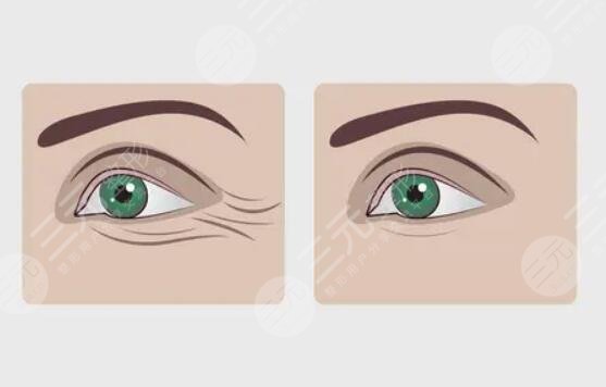 去皺紋的方法有哪些?