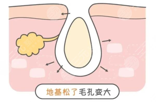 怎么收縮面部毛孔有又快速？文中3中方法你得學(xué)起來(lái)！如何預(yù)防是關(guān)鍵！