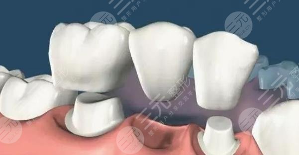 一般假牙價格多少?