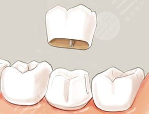 一般假牙價格多少?