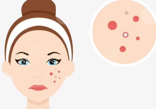 臉上痘坑可以修復(fù)嗎?