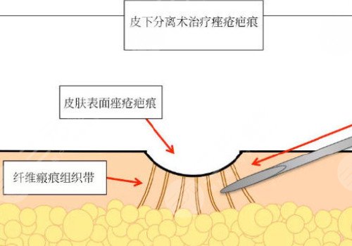 臉上痘坑可以修復(fù)嗎?