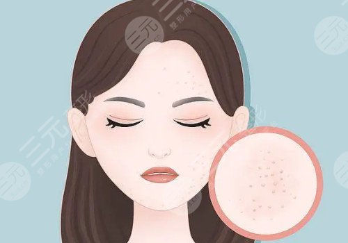 臉上痘坑可以修復(fù)嗎?