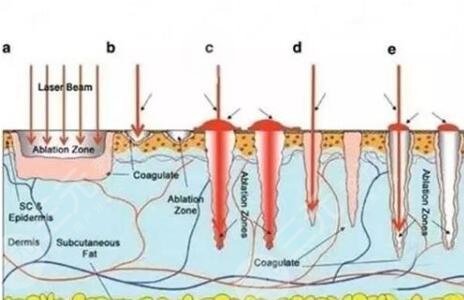 醫(yī)美消除紅腫的痘痘
