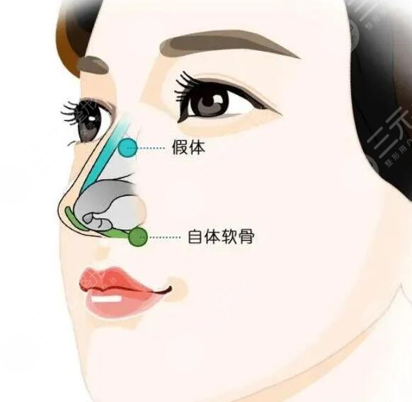 做完鼻梁的術(shù)后注意事項