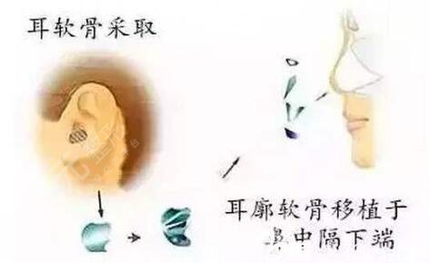 自體軟骨隆鼻果可以維持多久？