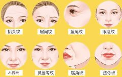 魚尾紋去除方法有哪些？分享6種，輕醫(yī)美帶你重塑無齡美眼！