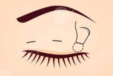 北京同仁醫(yī)院開眼角多少錢