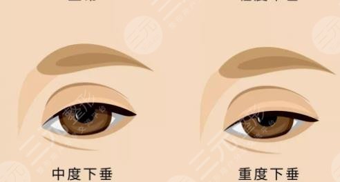 上瞼下垂術