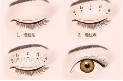不開刀的雙眼皮什么原理？手術(shù)知識超全科普！醫(yī)美小白必看~
