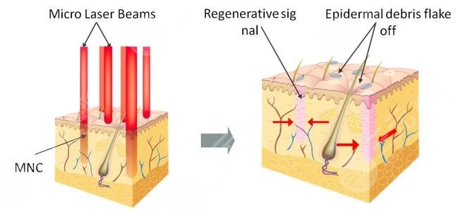 眼睛周圍長(zhǎng)脂肪粒怎么辦?