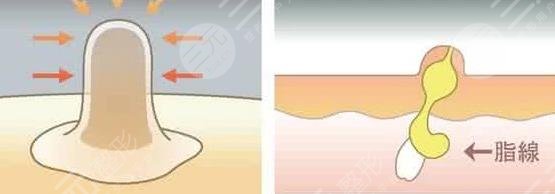 眼睛周圍長(zhǎng)脂肪粒怎么辦?