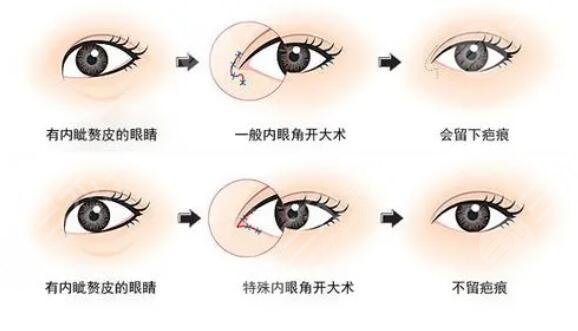開內眼角手術價格