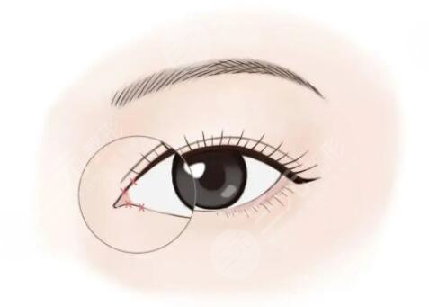 開內眼角會回縮成以前嗎?