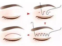 過(guò)程是怎樣的？韓式三點(diǎn)雙眼皮優(yōu)勢(shì)分析！