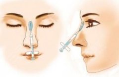 玻尿酸隆鼻多少錢？玻尿酸隆鼻價(jià)格貴嗎？