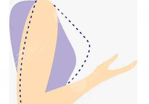 注射豐胸一般多少錢(qián)?