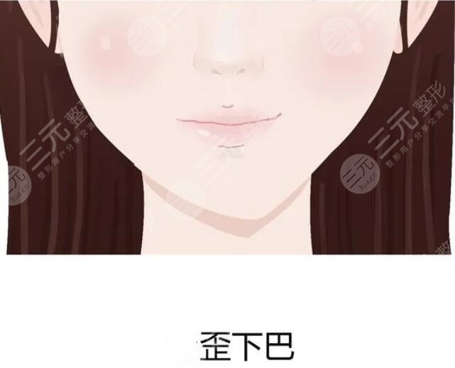 膨體隆下巴的術(shù)后護(hù)理