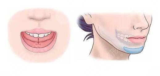 隆下巴假體恢復(fù)過(guò)程圖整理！隆下巴的手術(shù)過(guò)程是怎樣的？注意事項(xiàng)有哪些？