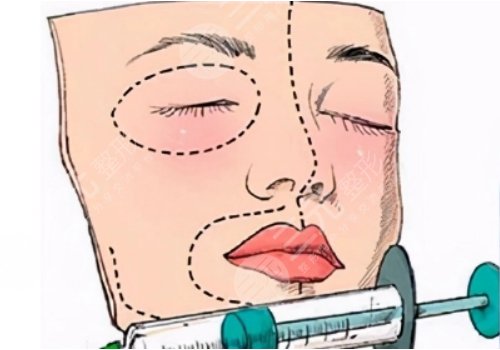 自體脂肪填充下眼瞼凹陷可以維持多久?