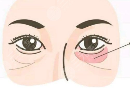 自體脂肪填充下眼瞼凹陷有哪些優(yōu)勢(shì)和弊端?