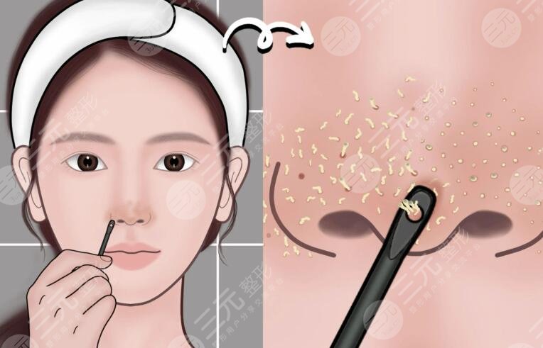 蘇打水去黑頭的注意事項