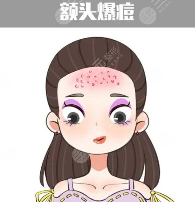 　　額頭上長痘痘的原因是什么呢?長痘痘是很多朋友的心頭大患，因為在進入青春期之后，很多朋友臉上都會或多或少的長出痘痘，痘痘又紅又腫，有的時候還有很多分泌物，一碰就很疼，這給大家?guī)砹撕芏嗟臒馈６幸徊糠峙笥鸭幢闶亲叱隽饲啻浩?，臉上仍舊有很多的痘痘存在。尤其是額頭上的痘痘特別的嚴重。實際上不同的部位痘痘生長都是有原因的，下面就針對額頭上的痘痘，我們進行深入的分析。  　　1、額頭上長痘痘的原因是什么?  　　痘痘又被大家稱作為痤瘡或者青春痘。一般在額頭上，臉上，胸部背部長得比較多。因為這些部位皮膚角質層比較薄，而且油脂分泌旺盛，給痘痘的生長提供了很好的條件。痘痘的生長是由于皮膚里面生產(chǎn)了大量的油脂，將毛孔堵塞。尤其是油脂栓塞了毛囊口加上周圍致痘細菌的影響，就形成了丘疹痘痘。這些痘痘一般呈現(xiàn)出紅色，用手輕輕擠壓就會擠出黑色的乳狀或者是乳白色的脂栓。  　　因為痘痘生長的位置比較靠近皮膚較深的部位，所以這些痘痘與周圍組織有緊密的聯(lián)系。如果痘痘變得過于的大或者過于深，很容易引起炎癥。有時痘痘生長以后不容易干癟脫落，有形成暗瘡和痘坑痘印的風險。青春期生長痘痘的幾率比較大。因為青春期的時候，人體內分泌容易紊亂，雌性激素和雄性激素分泌的情況會發(fā)生變化，所以就很容易生長痘痘。  　　2、去除痘痘的方法  　　去除痘痘要內外兼治，首先要調節(jié)飲食。少吃辛辣的食物，不吃油膩的食物，對于膨化食品也要少吃。這些食物有很大的刺激性，對于身體來講容易產(chǎn)生消化負擔，而且容易堆積垃圾，產(chǎn)生毒素。多吃維生素含量高的食物與水果，調節(jié)脾胃功能，促進腸胃蠕動，可以加快毒素的排出。  　　如果身體里有內分泌紊亂的現(xiàn)象，可以吃藥物調節(jié)。目前比較多的是四環(huán)素多，西環(huán)素米諾環(huán)素等這些藥物。可以使皮膚的脂肪酸濃度下降，抑制丙酸痤瘡菌的活性使青春痘生長喪失溫床。適當?shù)倪\動。運動的時候身體產(chǎn)生大量的熱量。毛孔也會打開釋放熱能。隨著大量汗液的流出，也會有很多垃圾和油脂被排出體外給皮膚做深層潔面。  　　痘痘生長的過程中，不要用手去擠壓或者觸碰，可以涂抹消腫藥膏。蘆薈膠、祛痘膏都可以涂抹。避免因為錯誤的方法把痘痘變得紅腫，干癢產(chǎn)生炎癥，留下痘坑痘印兒。當痘痘生長過于密集的時候，可以采用鐳射激光，光子嫩膚，二氧化碳，點陣激光等方式來緩解痘痘。  　　3、額頭上長痘痘的案例介紹  　　青春期之后我的額頭開始長痘痘，有很多人告訴我，青春期過后痘痘就會消除，可是我千辛萬苦等到青春期結束直到二十幾歲，額頭上的痘痘一直沒有停止過生長，后來去看醫(yī)生，醫(yī)生說額頭上的痘痘映射了新陳代謝不好的問題。建議我可以嘗試一下內服藥物調理內分泌系統(tǒng)。于是我就在醫(yī)生的建議下，吃了大概三個月的中藥。  　　中藥的主要作用就是舒筋活絡，加速代謝，排解垃圾。自從吃了中藥以后，我感覺自己整個身體經(jīng)營了很多，很多之前會有習慣性的便秘，但是慢慢的身體的消化系統(tǒng)舒適了，不再出現(xiàn)胃酸反胃便秘等這些問題。大概在吃藥后的一個月再次來月經(jīng)的時候，臉上并沒有長出原來那么多痘痘，只是少許的幾顆，這讓我看到了曙光，于是連續(xù)吃了三個月，現(xiàn)在基本調理好了。