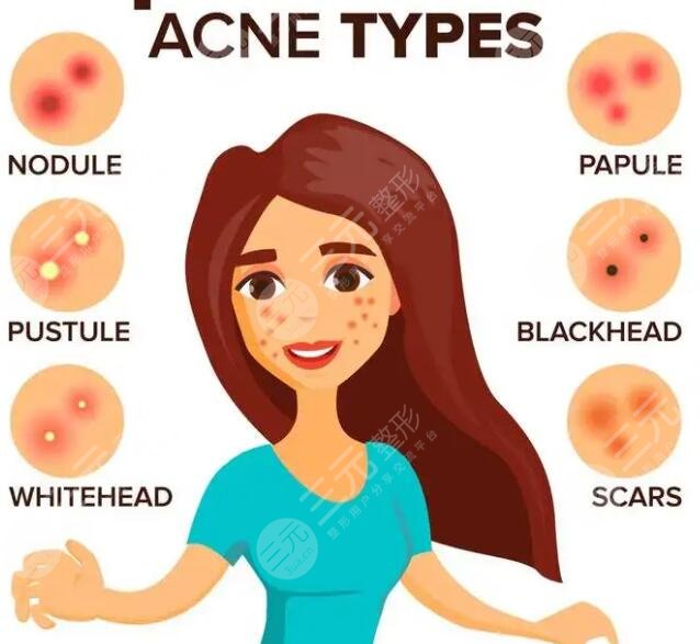 復(fù)合彩光去痘幾次有?