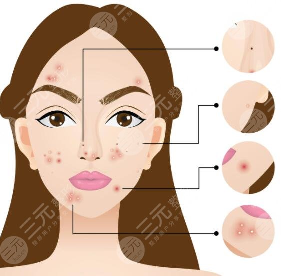 復(fù)合彩光祛痘的案例介紹