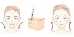 玻尿酸注射的價(jià)格是多少？注射玻尿酸有什么作用？