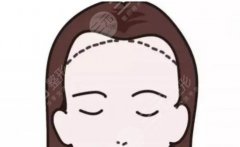 發(fā)際線太高了怎么挽救？有哪些注意事項(xiàng)呢？