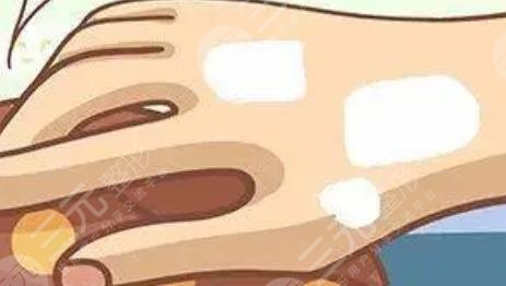 皮膚出現(xiàn)白塊