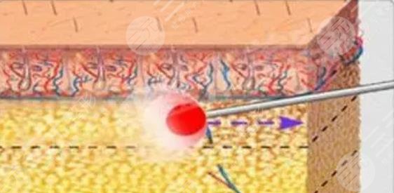 等離子激光溶脂