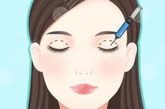 激光雙眼皮能保持幾年？做完雙眼皮之后多久能恢復自然？