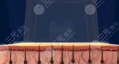 冷光脫毛要做多少次？原理&注意事項(xiàng)超全科普！MARK~