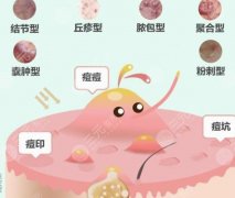 痤瘡緩解需要多少錢？?jī)r(jià)格公開(kāi)！祛痘術(shù)后注意事項(xiàng)超全干貨~