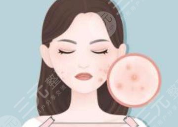 如何緩解青春痘粉刺？痤瘡生長(zhǎng)的原因是什么？注意事項(xiàng)介紹