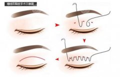 雙眼皮埋線手術(shù)能維持多久？手術(shù)原理是什么？注意事項分享