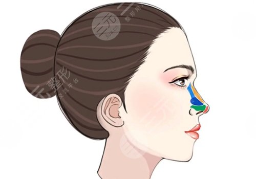 塌鼻子隆鼻后會(huì)好看嗎?