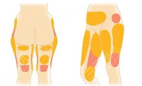腿部吸脂需要多少錢(qián)一般?