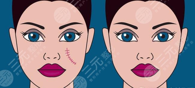 緩解疤痕好的方法有哪些？這3種方法目前來看果！看看哪種適合你？