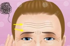 怎么樣去除抬頭紋？醫(yī)美除皺方式4種介紹，科普帶你重塑平滑美肌！